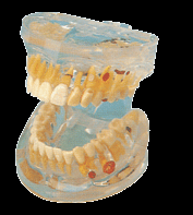 供应透明牙体病理模型