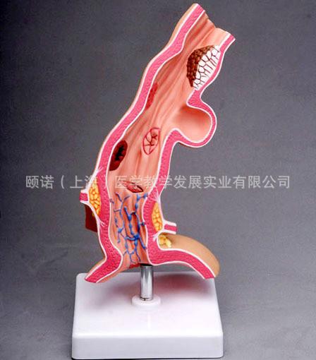 供应食管病理模型食管疾病模型食管模型食管解剖模型