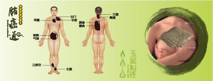 供应玉泥心经泥灸“肺癌通”