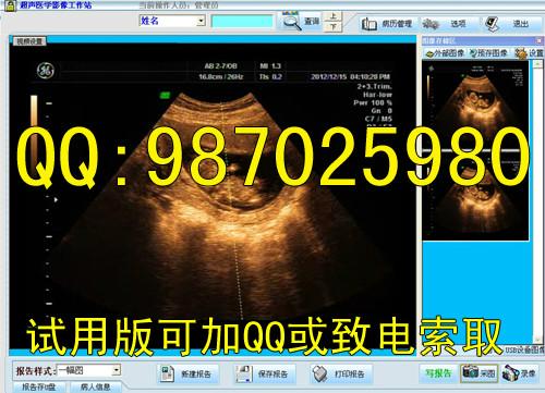 碎石b超软件超声碎石工作站软件批发